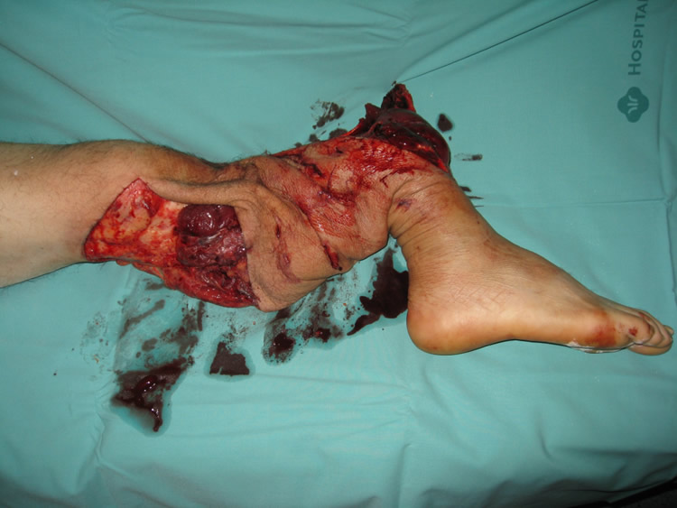 Aplastamiento severo — estado inicial