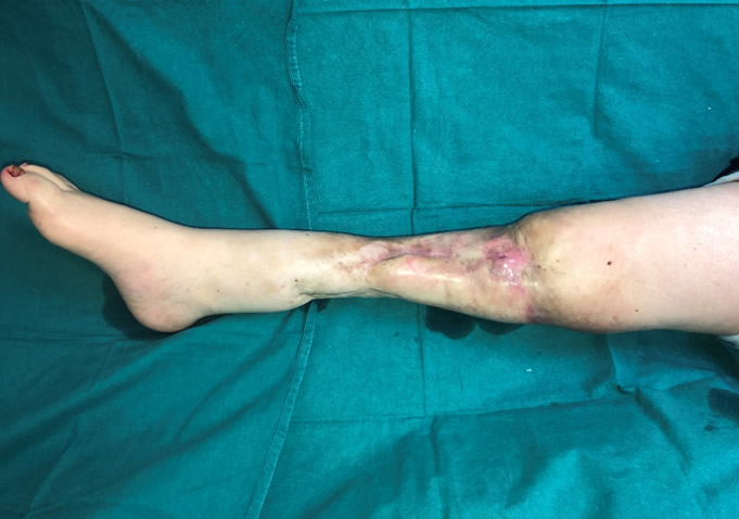 Megaprótesis oncológica infectada — estado inicial