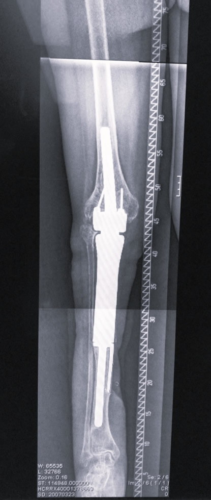 Radiografía — defecto esquelético