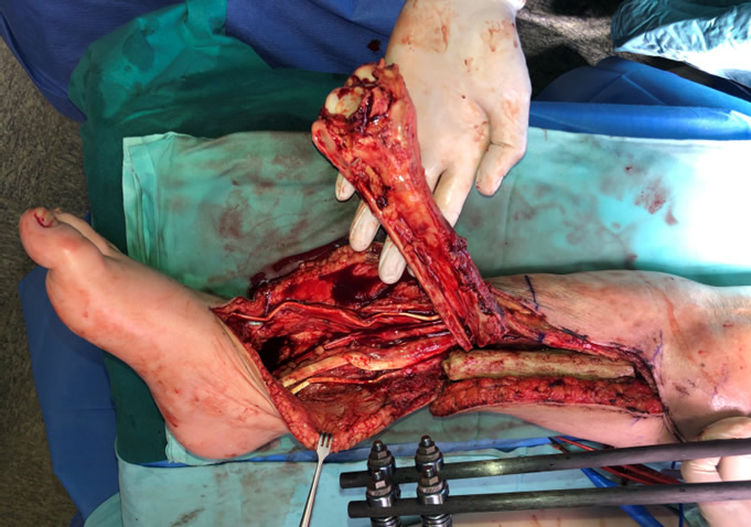 Intraoperatorio — transferencia tobillo vascularizado