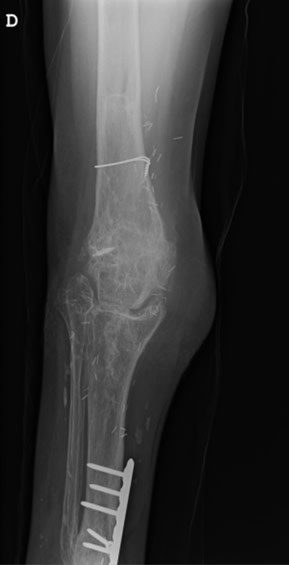 Radiografía — tobillo consolidado en posición de rodilla