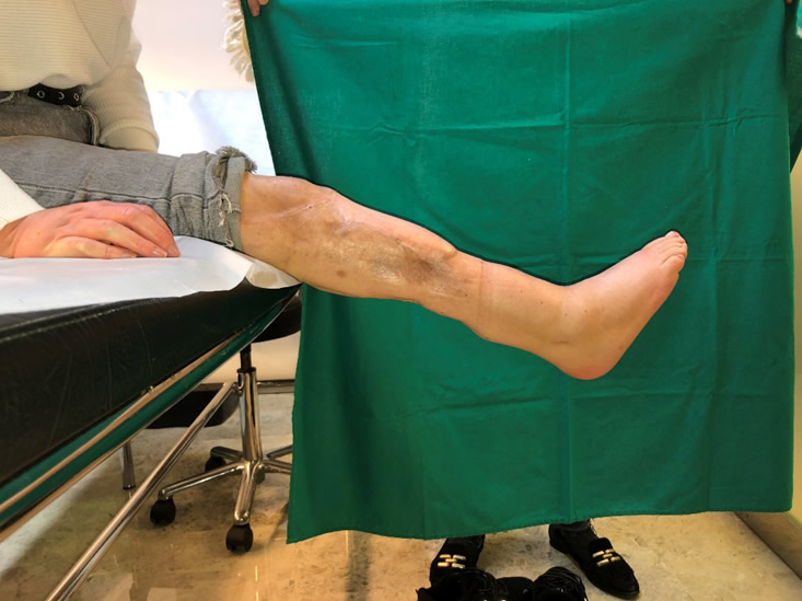 Resultado funcional a los dos años