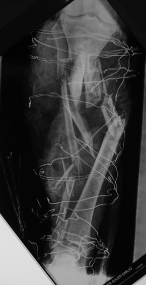 Fractura hiperconminuta de tibia