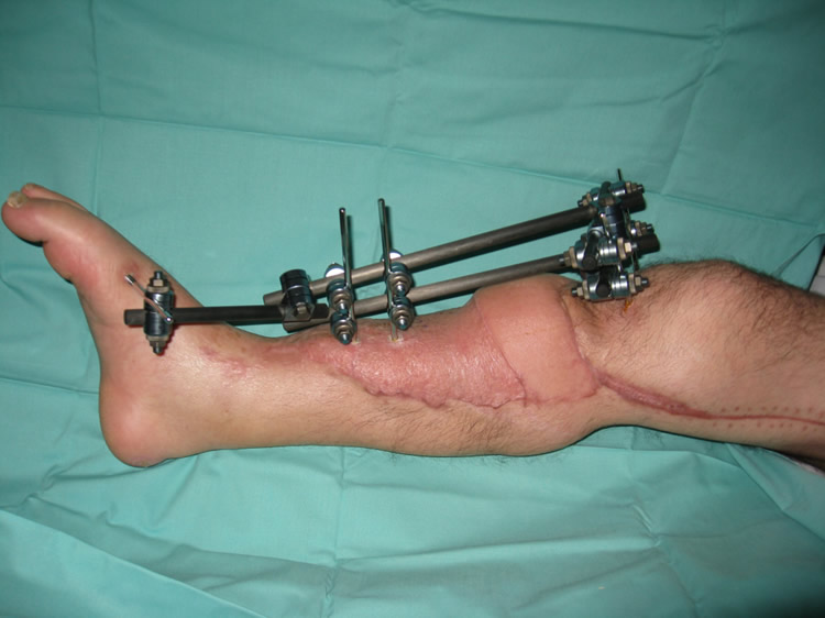 Cobertura microvascular — latissimus dorsi