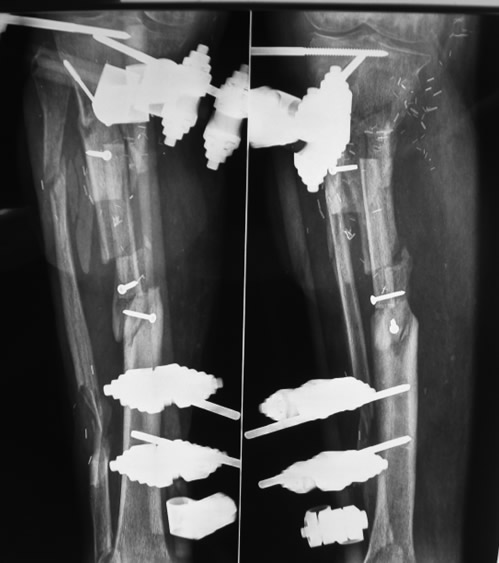 Reconstrucción ósea — peroné contralateral