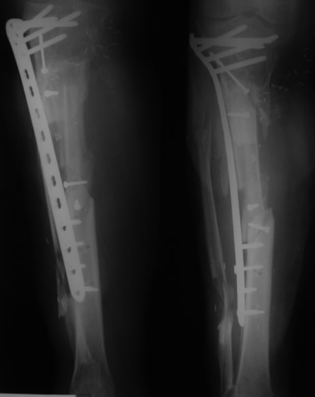 Fijación interna definitiva