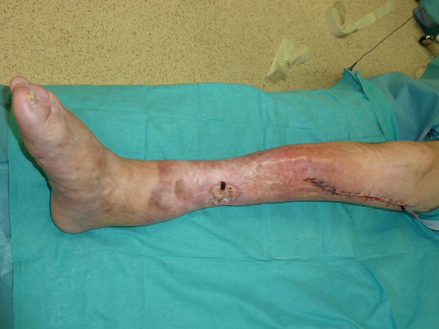 Cobertura inestable — estado inicial