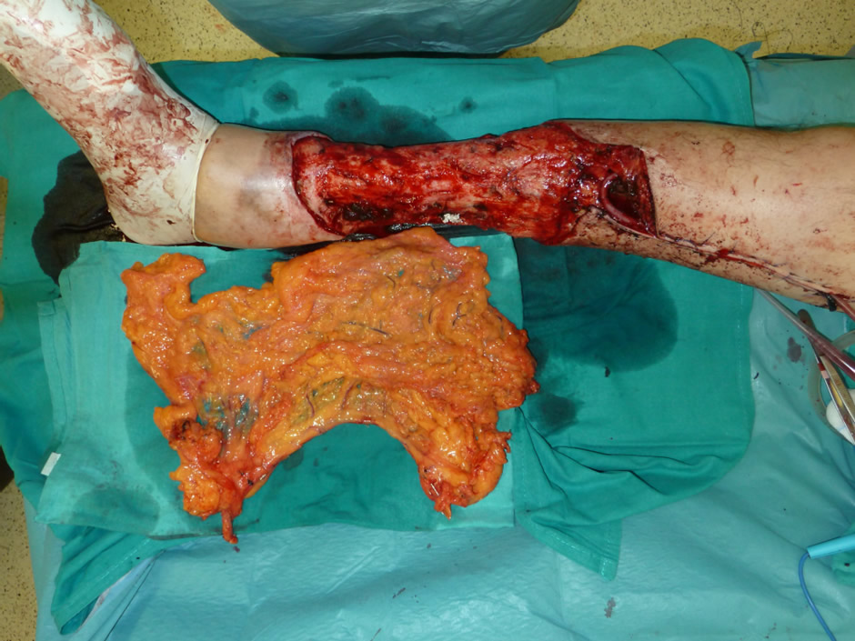 Defecto masivo e injerto de epiplón microvascular