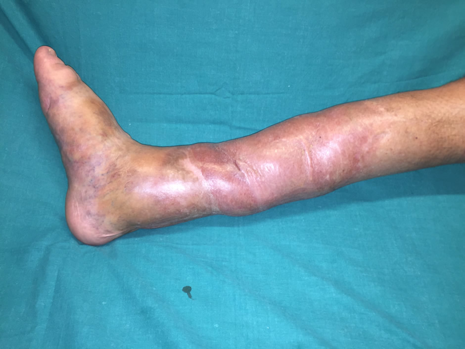 Resultado a los tres años — circunferencia completa