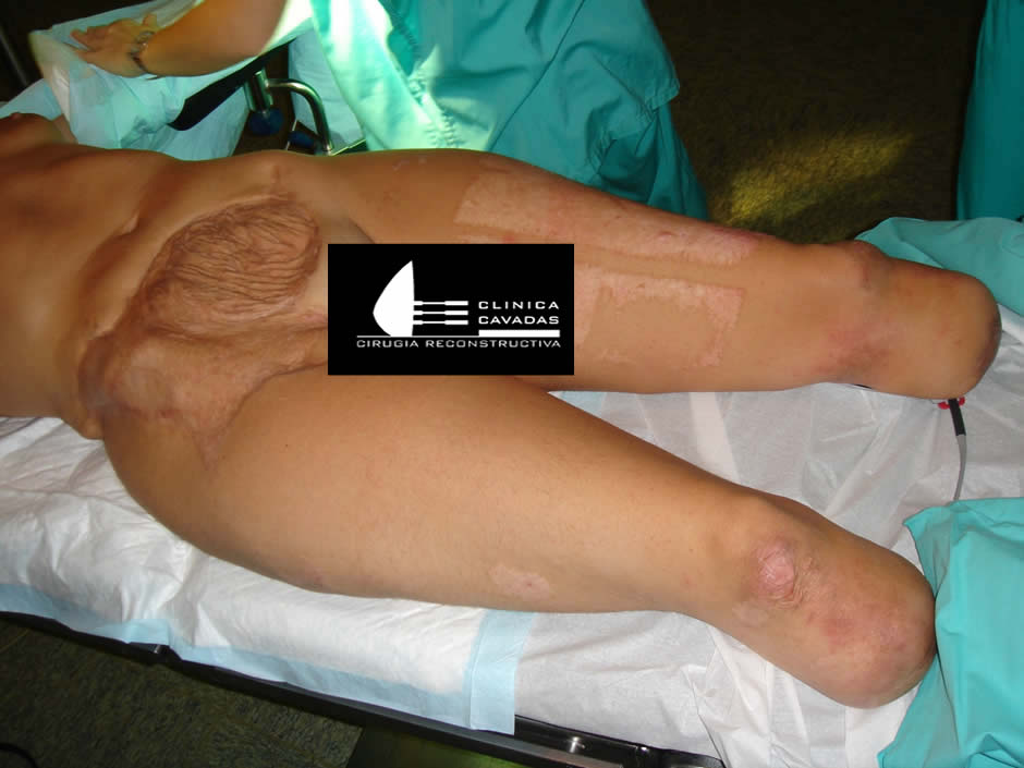 Paciente con pérdida de ambas piernas y pared abdominal infraumbilical