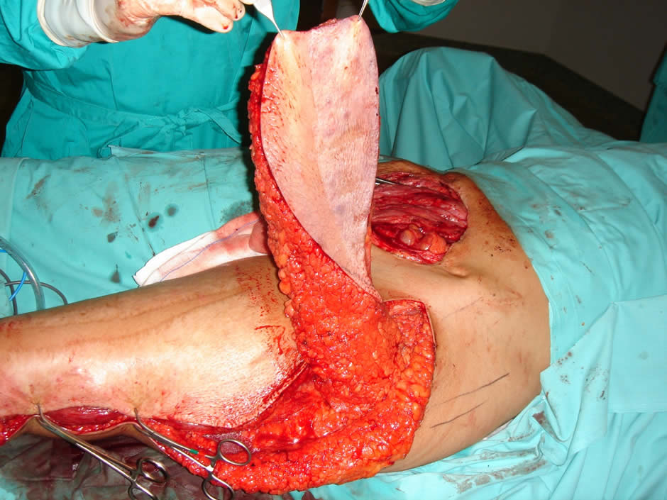 Resultado postop. Cicatrices ocultables con ropa interior. Pared abdominal competente