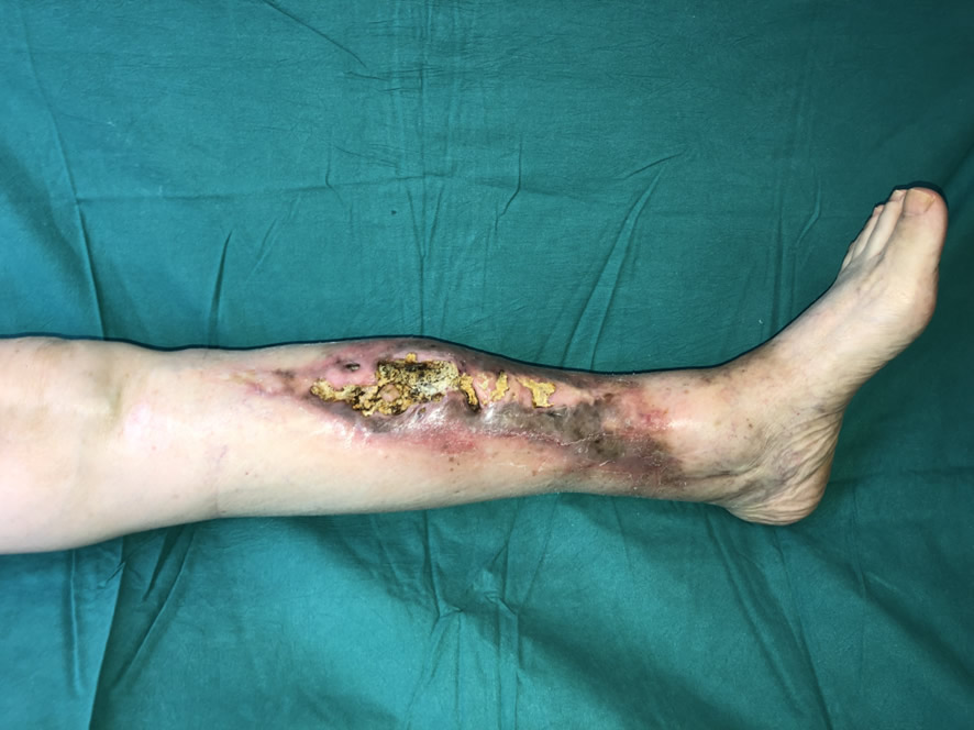 Osteomielitis crónica — estado inicial