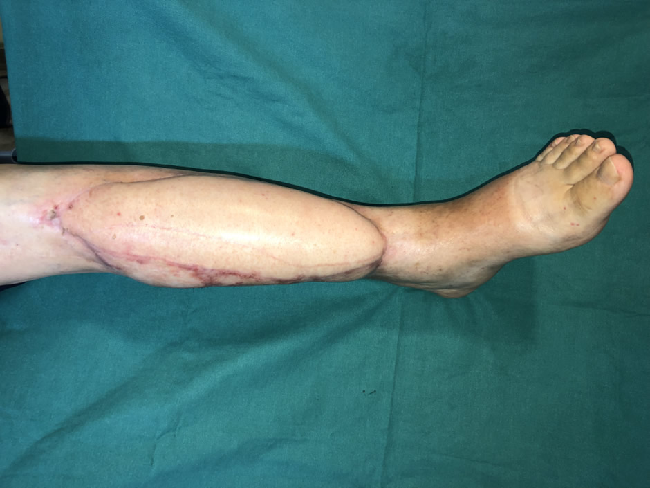 Resección ósea y cobertura microvascular