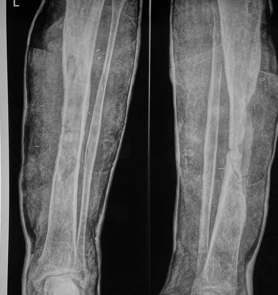 Fractura de tibia residual