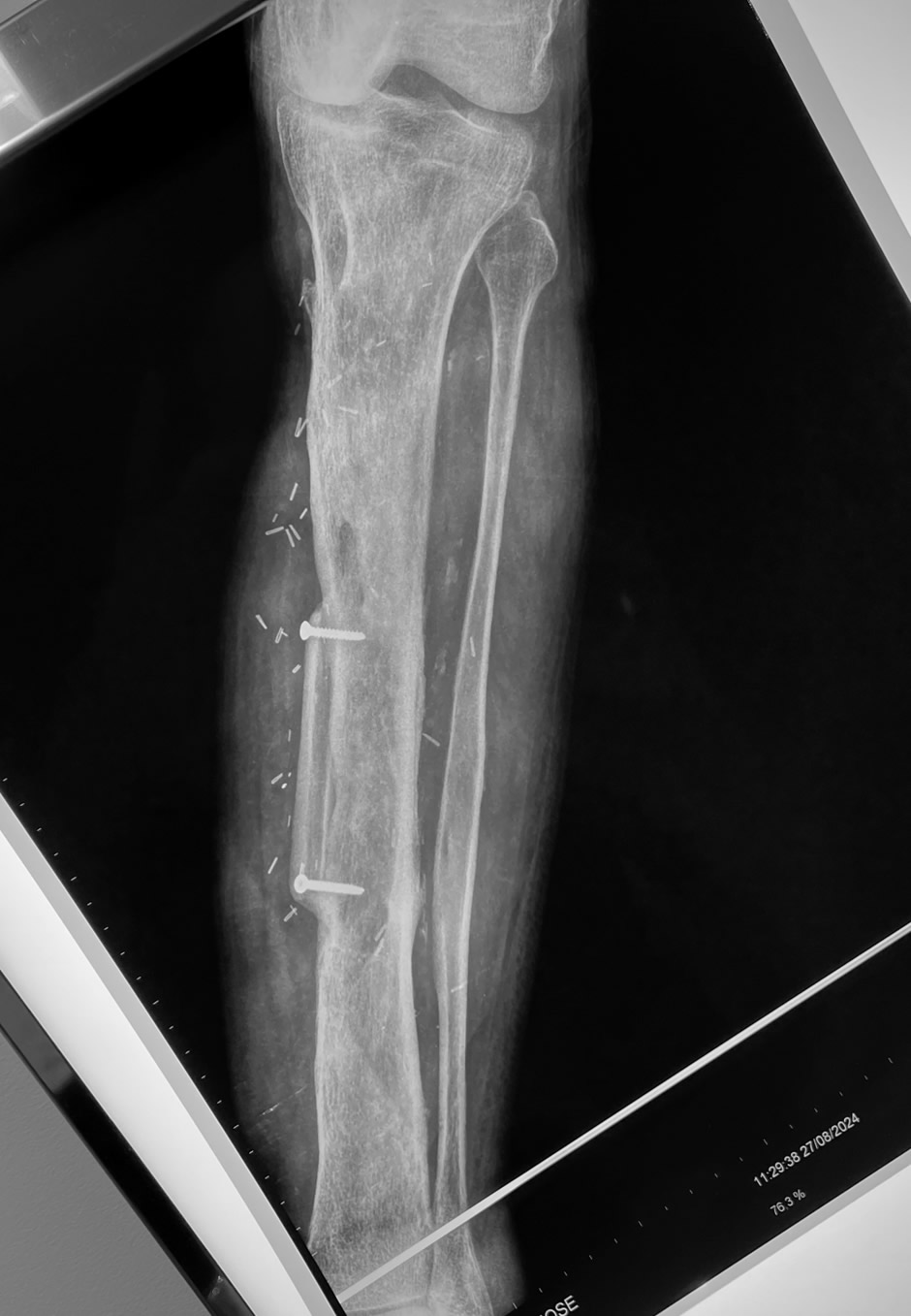 Reconstrucción ósea — peroné microvascular