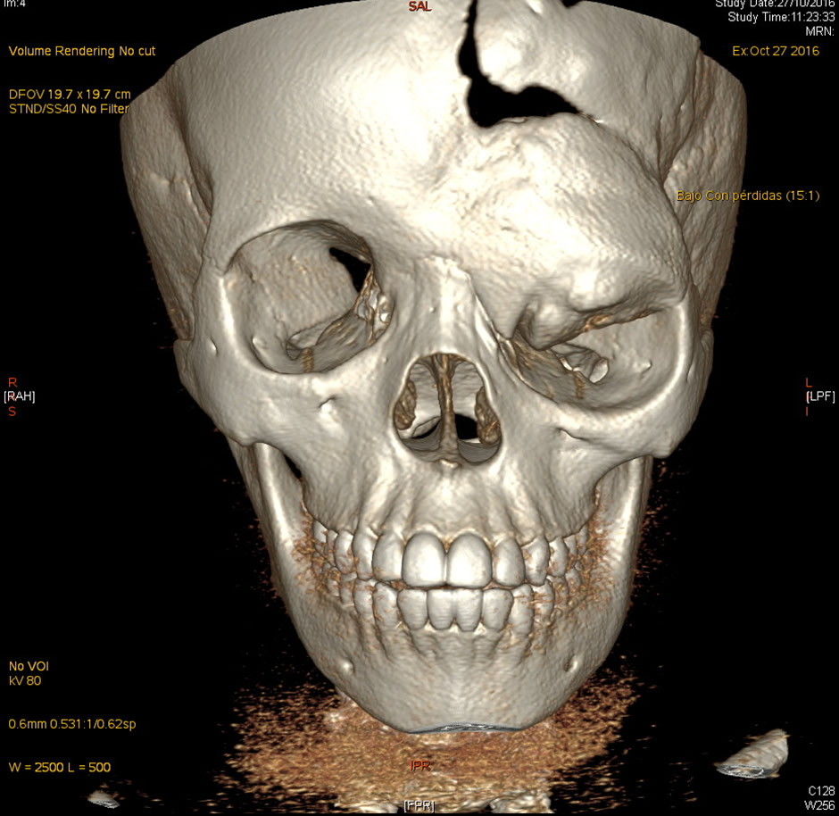 TAC 3D — deformidad frontoorbitaria