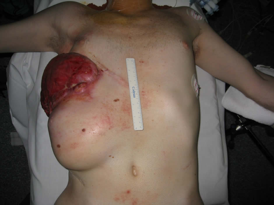 Paciente con tumor desmoide de pared masivo