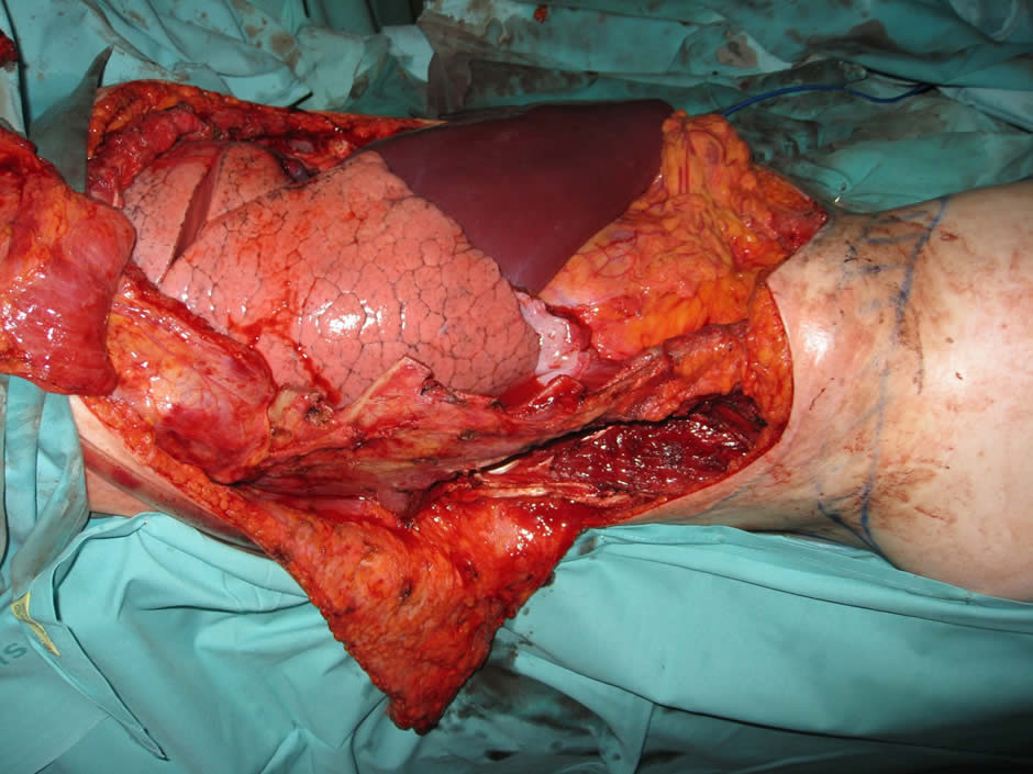 Extension de la resección. Pulmón, hígado y contenido abdominal requieren cobertura estable