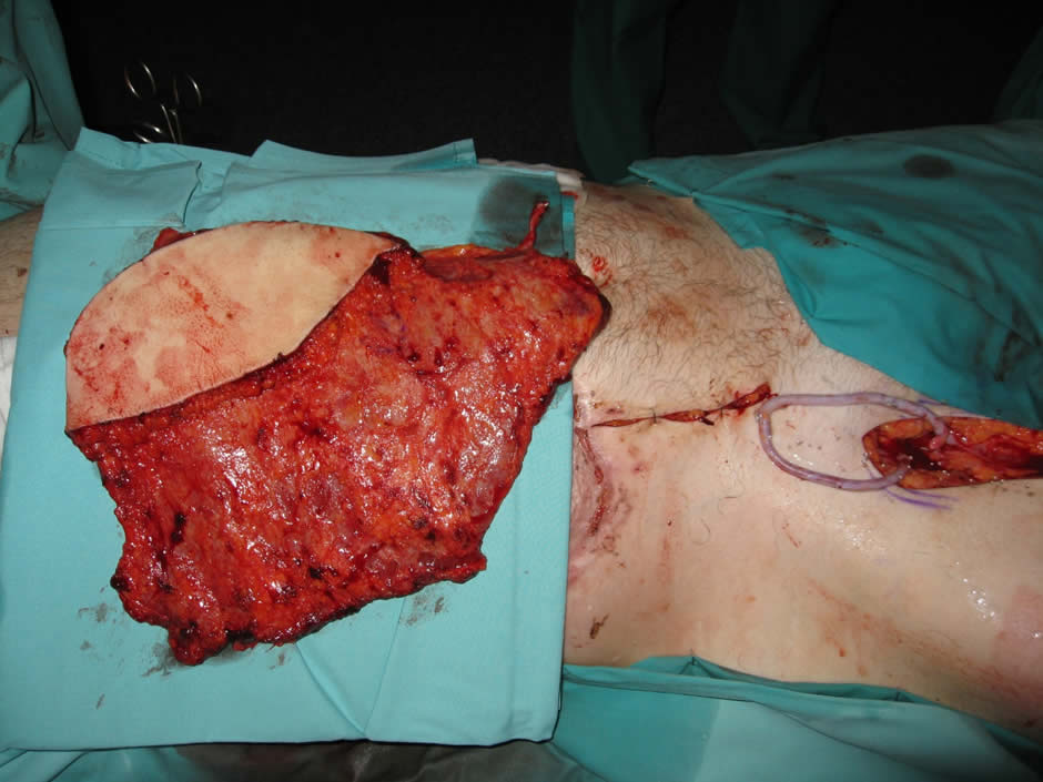 Reconstrucción con transferencia microvascular latissimus dorsi conectados a vasos femorales