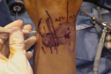 Artroscopia de muñeca — intervención en quirófano