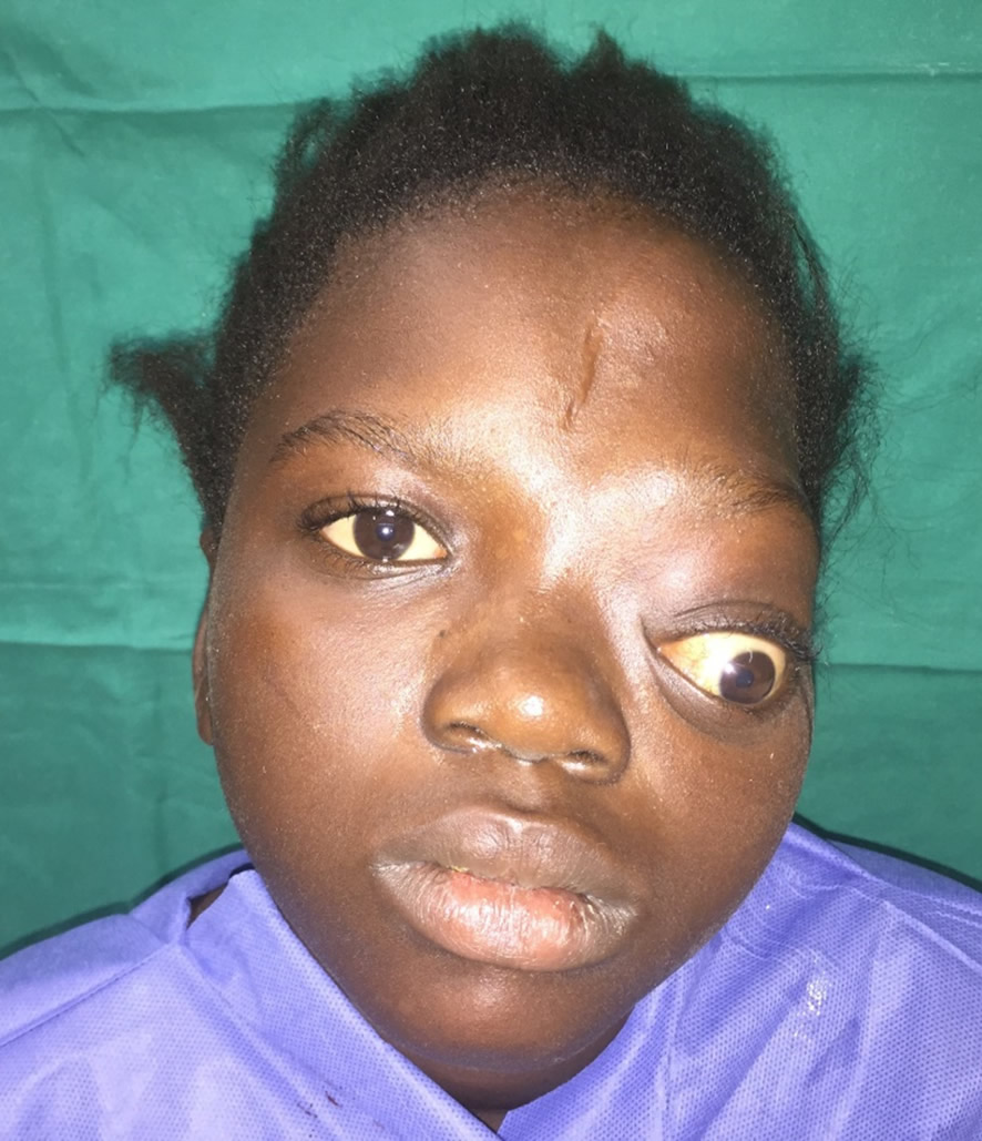 Deformidad frontoorbitaria — estado inicial