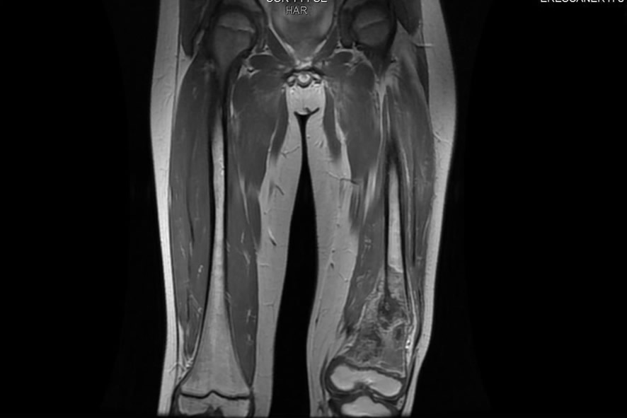 RM osteosarcoma femoral distal