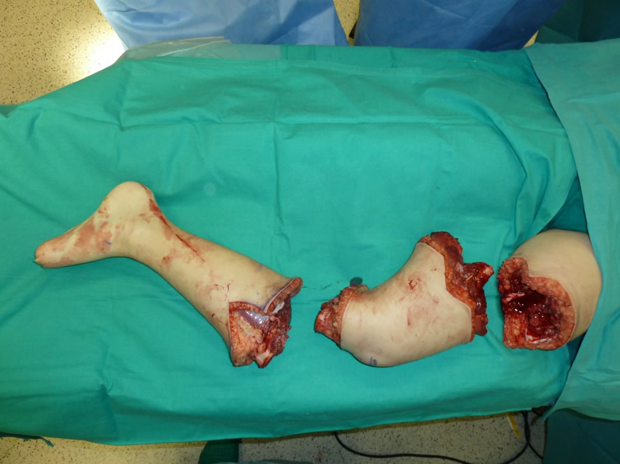 Pieza resecada — tumor con márgenes de seguridad