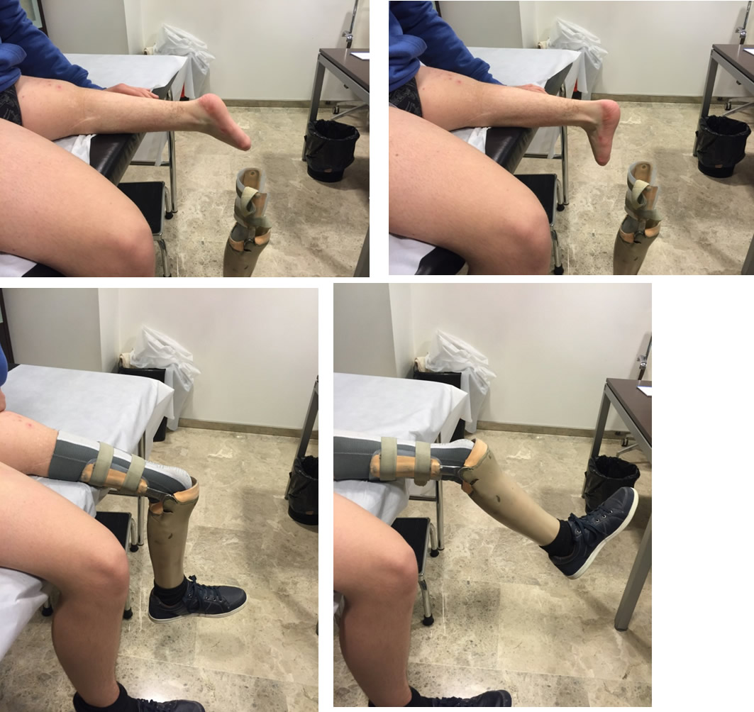 Resultado funcional con y sin prótesis