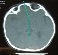 TAC 3D — Vista anterior