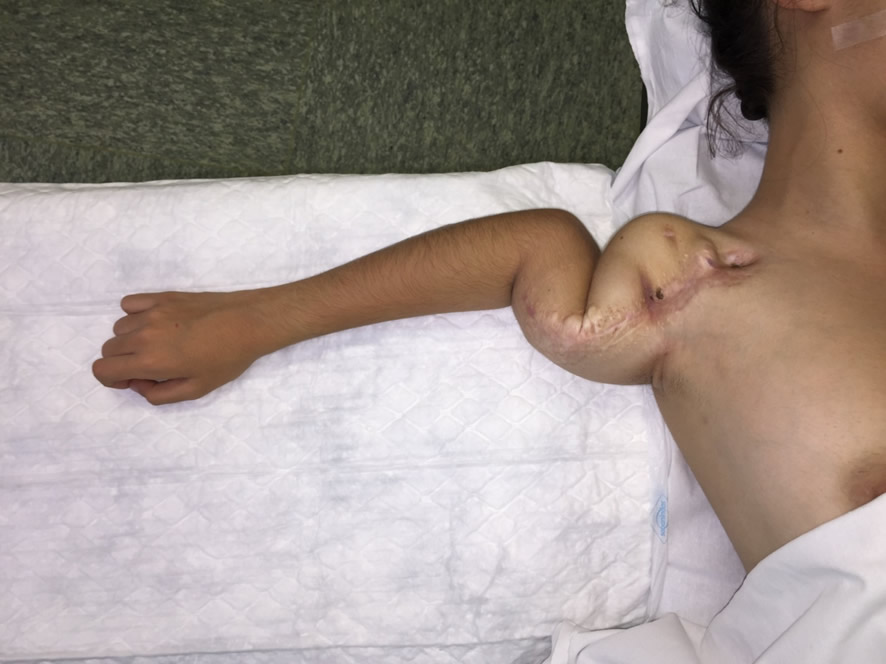 Inestabilidad severa por defecto masivo de húmero