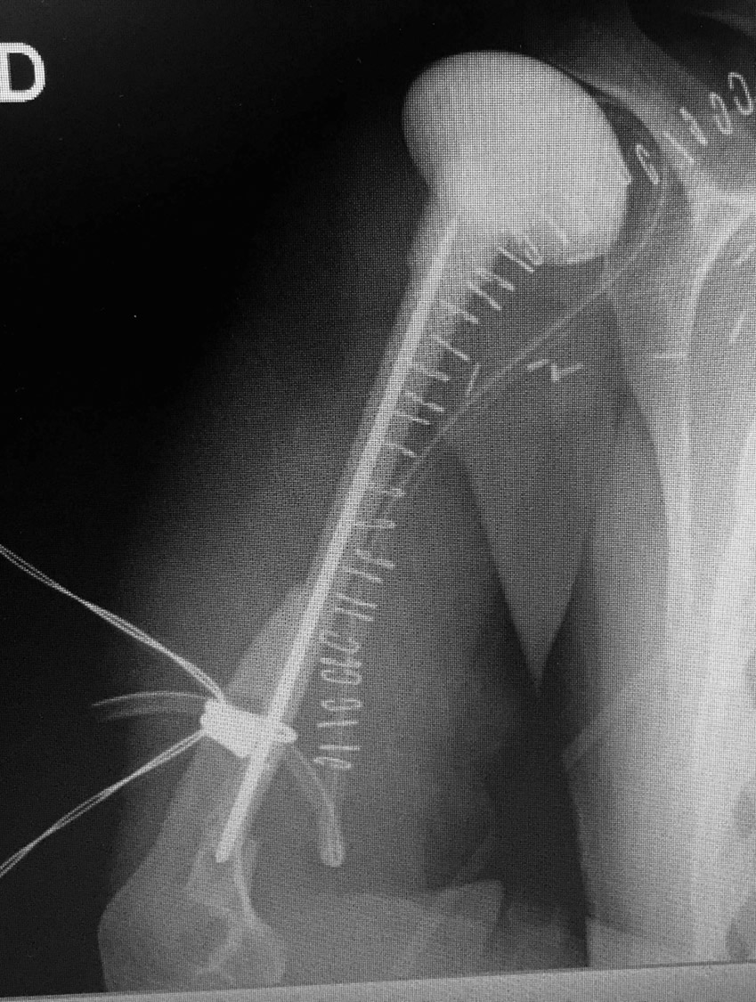 Radiografía preop — extrusión espontánea de prótesis