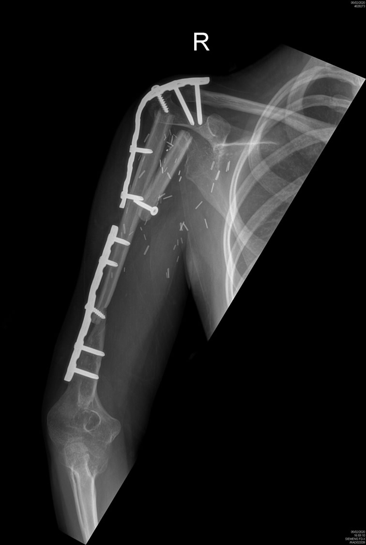 Radiografía postop — reconstrucción esquelética
