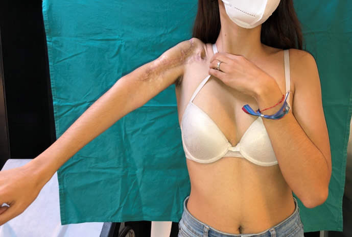 Resultado funcional a los dos años (2)