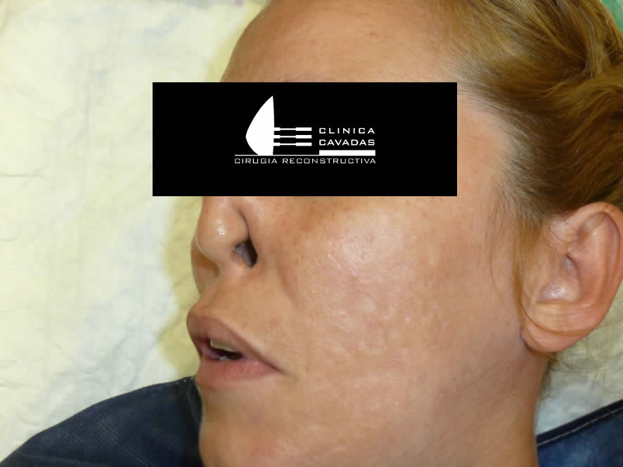 Colapso nasal severo — estado inicial