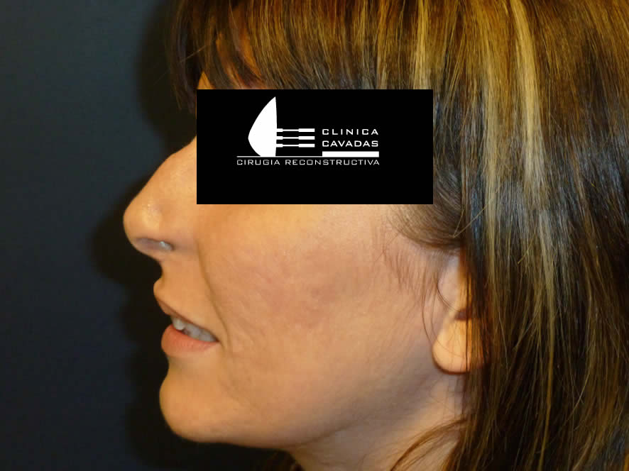 Resultado final — reconstrucción nasal