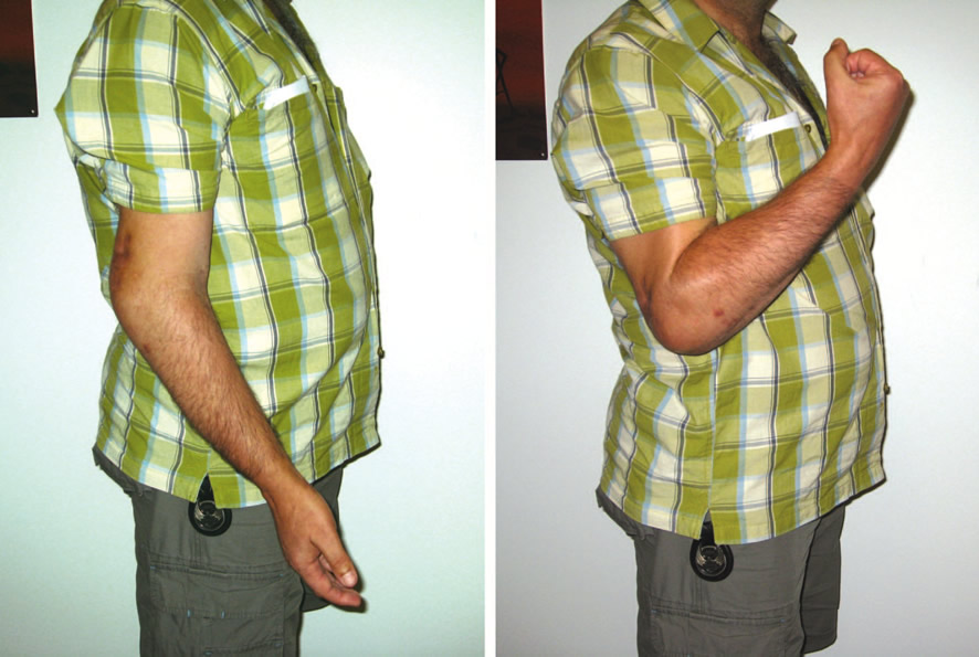 Resultado funcional a los 5 años