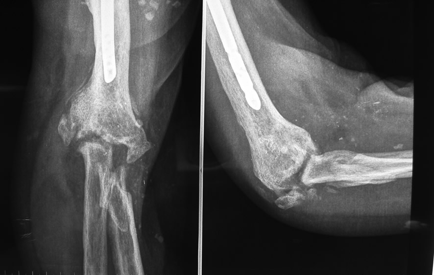 Radiografía preop — destrucción articular codo