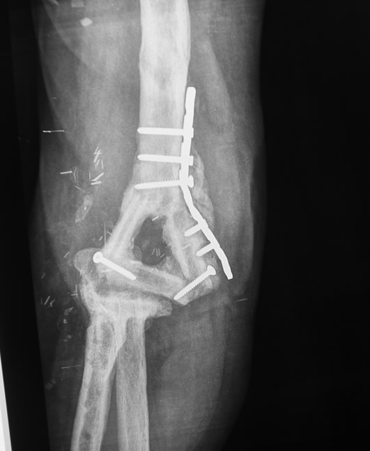 Radiografía postop — superficies articulares reconstruidas
