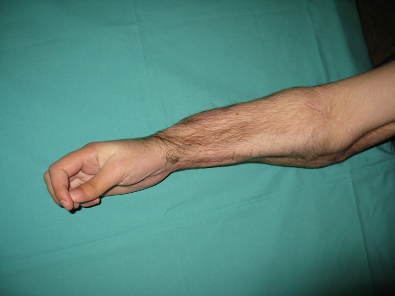 Resultado funcional a los dos años