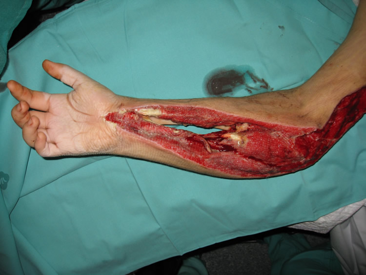 Pérdida masiva de tejidos — estado inicial