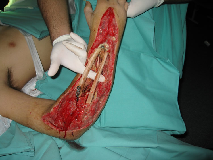 Necrosis de cúbito y radio