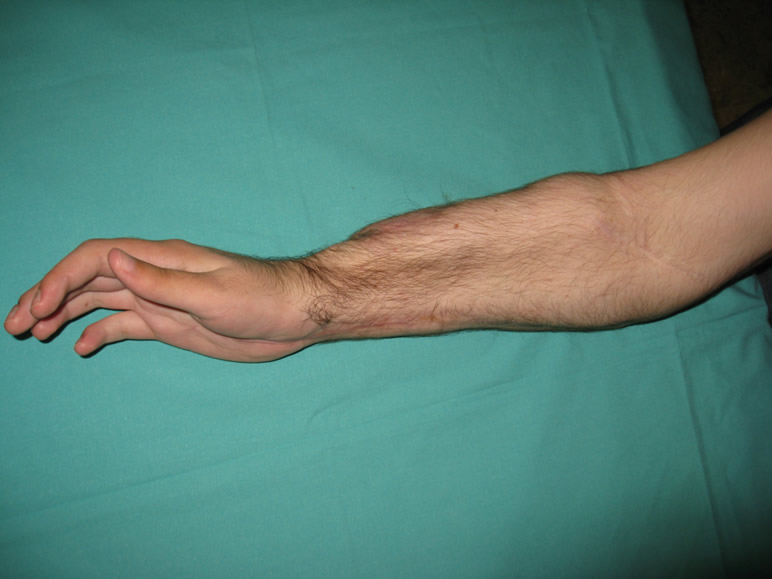 Resultado postop a los dos años