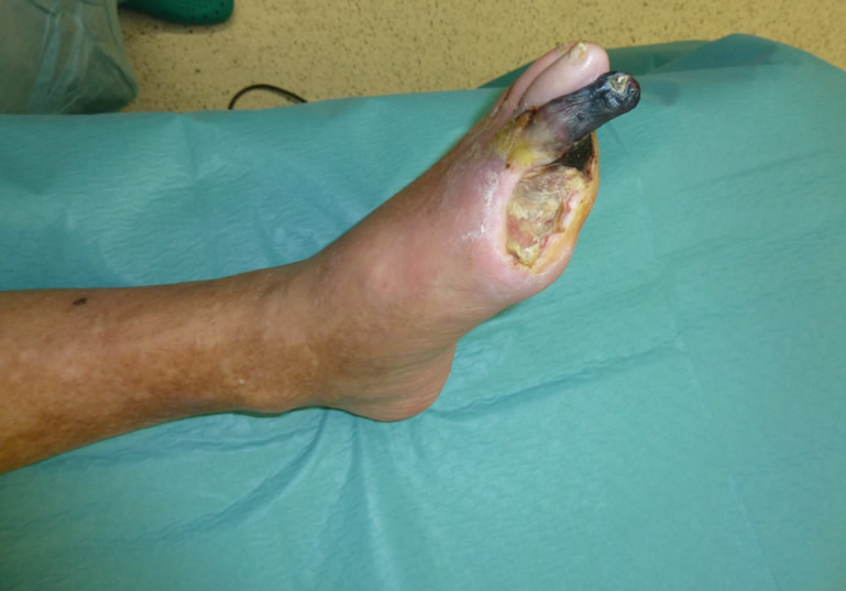 Isquemia crítica grado IV — estado inicial