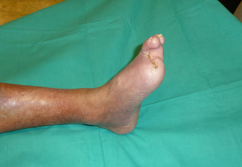 Resultado tras bypass — heridas cerradas