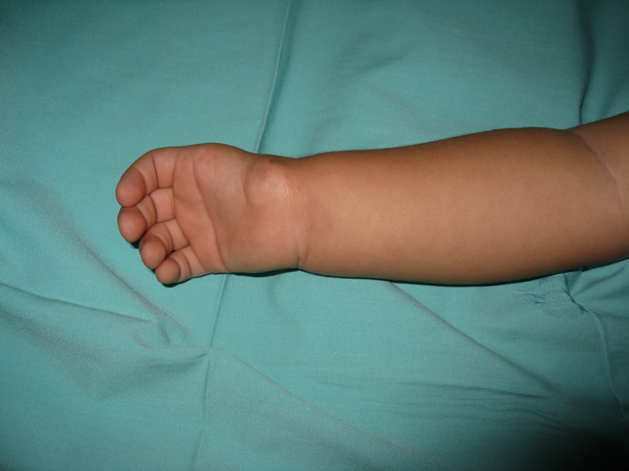 Hipoplasia de pulgar Blauth V — estado inicial