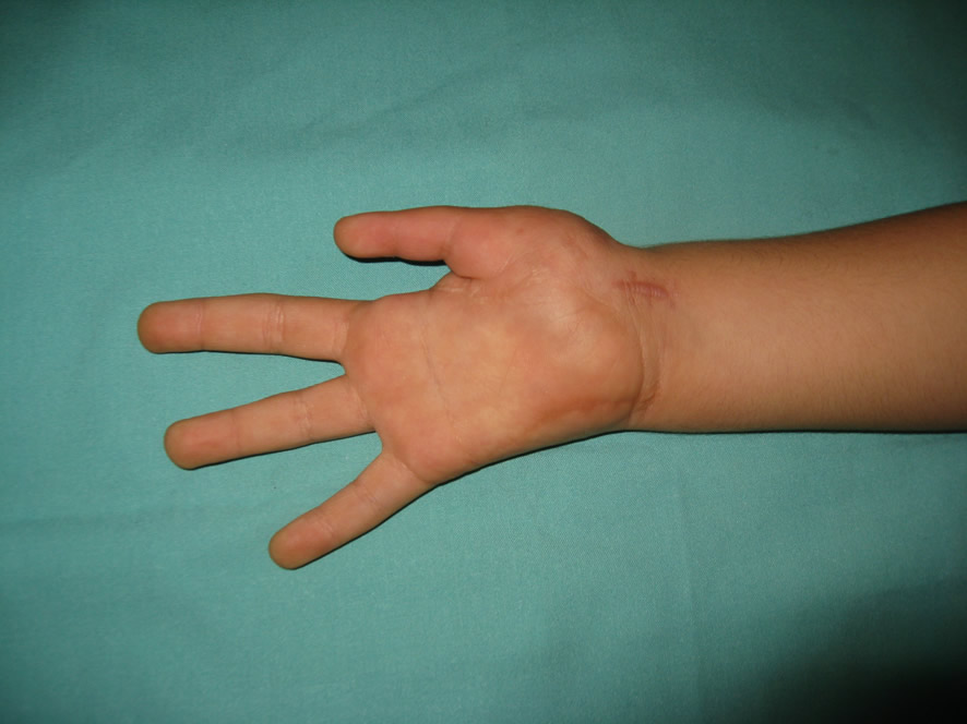 Postop a los 12 meses