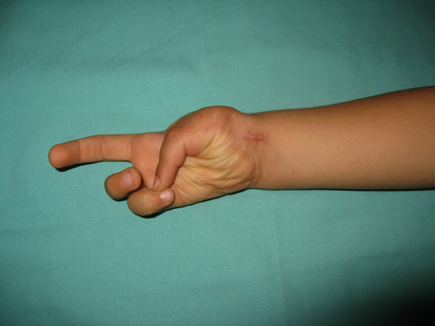 Resultado funcional del pulgar reconstruido
