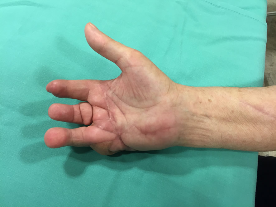 Resultado tras reconstrucción secundaria