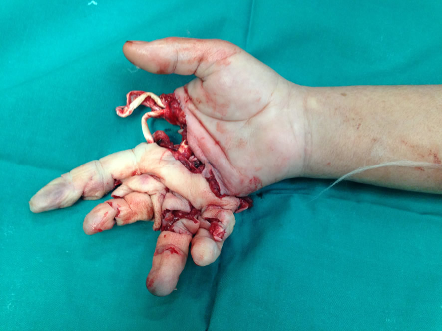 Lesión por picadora — estado inicial