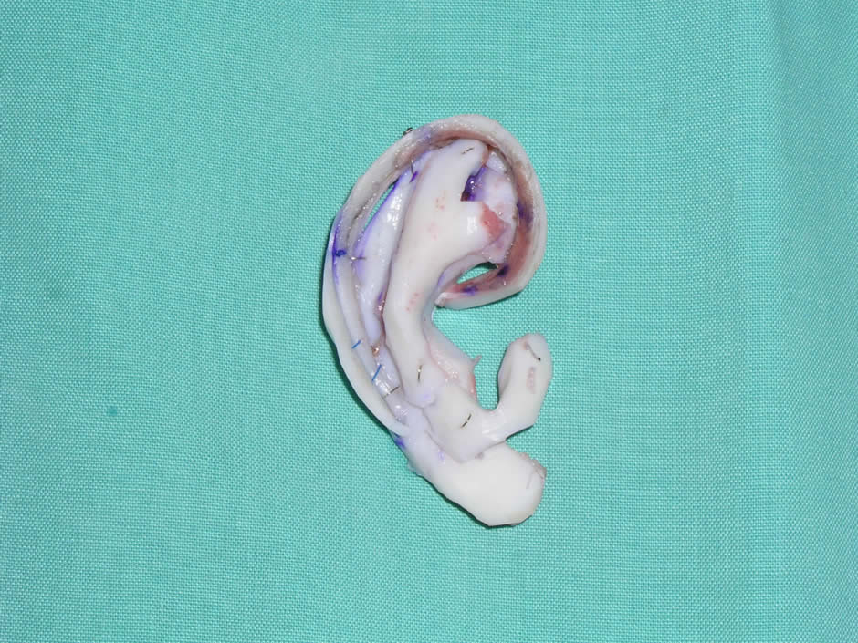 Construcción de esqueleto auricular con cartílago costal